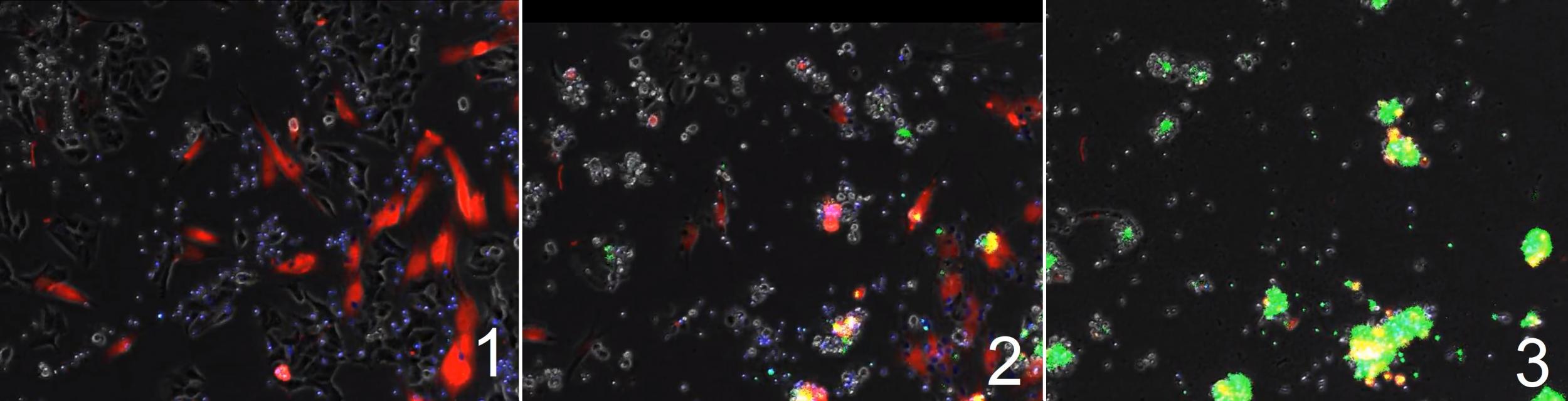 Stills from a time lapse animation show fibroblasts (red), T-cells (blue, small and round), cancer cells (black) and dying cells in green. As cancer cells are infected with the enadenotucirev virus, they produce bispecific T-cell engager (BiTE) protein before they die. BiTE then causes T-cells to latch on to and destroy fibroblasts (J Freedman/Cancer Research)