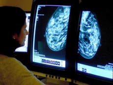 Four out of 10 cancer patients initially misdiagnosed, finds report warning of pressures in testing