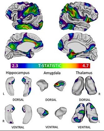 The outer regions of the brain cortex (above) and inner structures (below) which show the greatest effect in response to childhood socioeconomic status