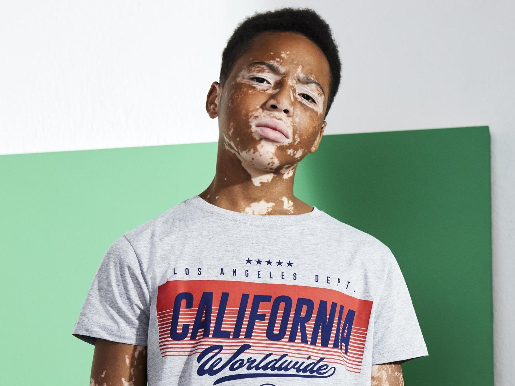 Primark has been praised for featuring a model with vitiligo