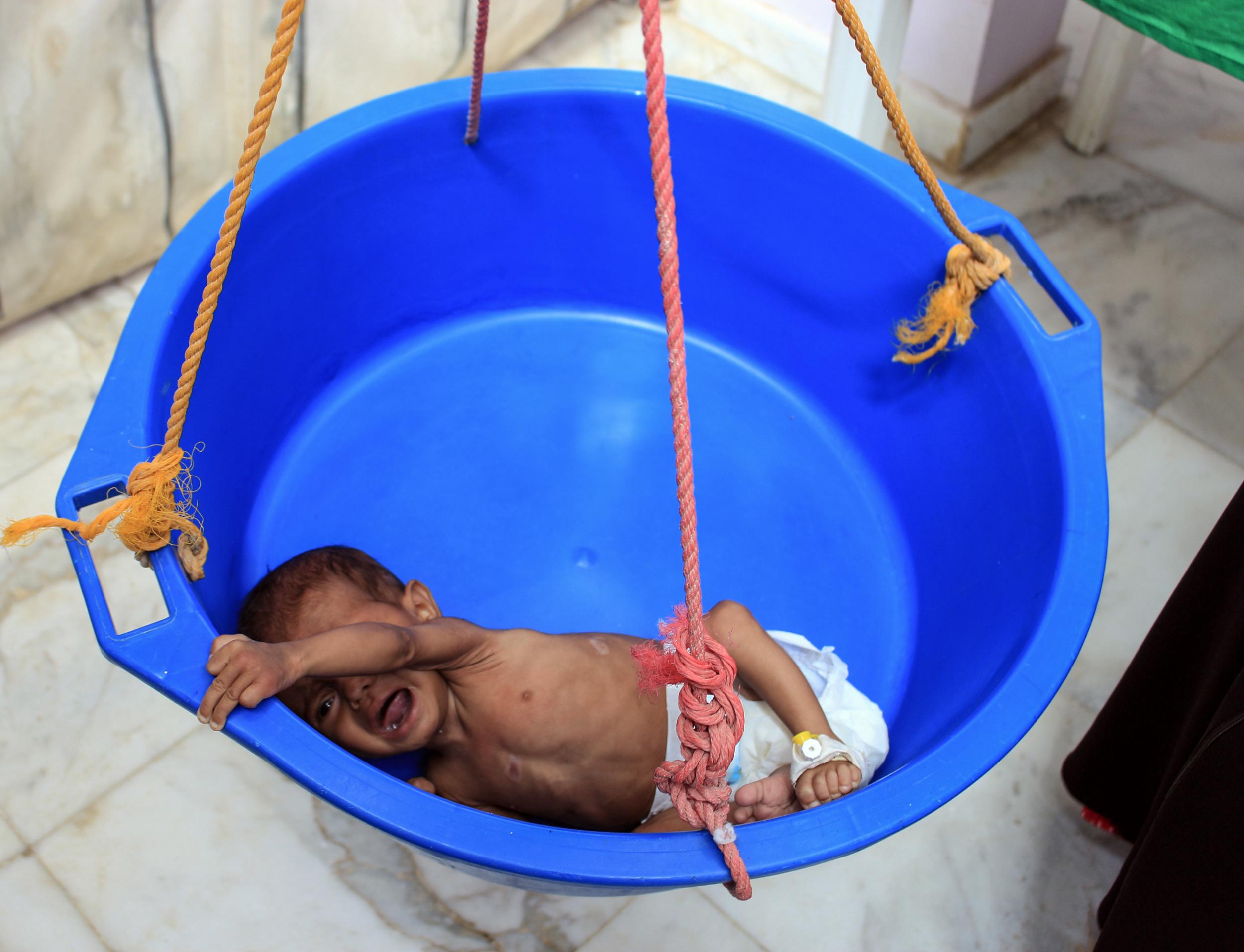 A Yemeni child suffering from severe malnutrition is weighed at a hospital in Yemen’s northwestern Hajjah province, where a camp for the displaced was hit by shelling this week