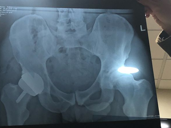 A picture of an x-ray after Andy Murray underwent hip surgery