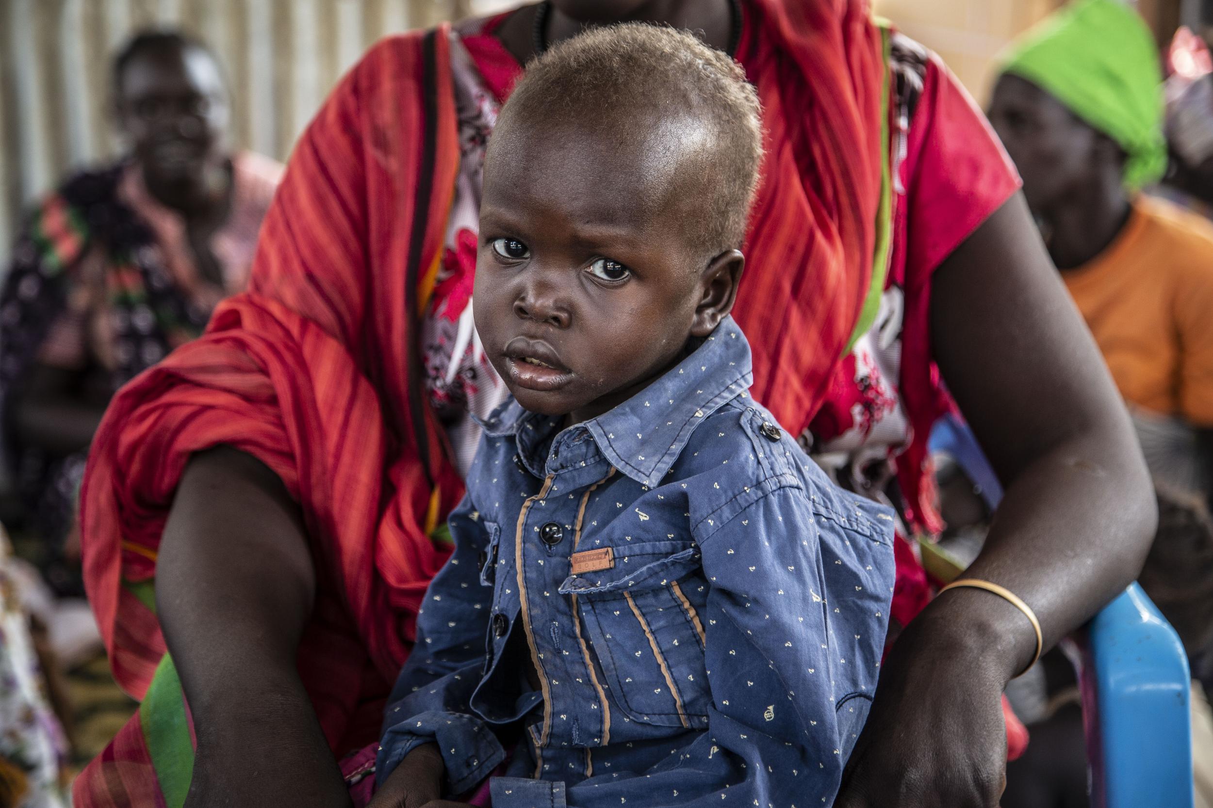 A little boy, who suffers from severe malnutrition, is being treated at a clinic in Juba