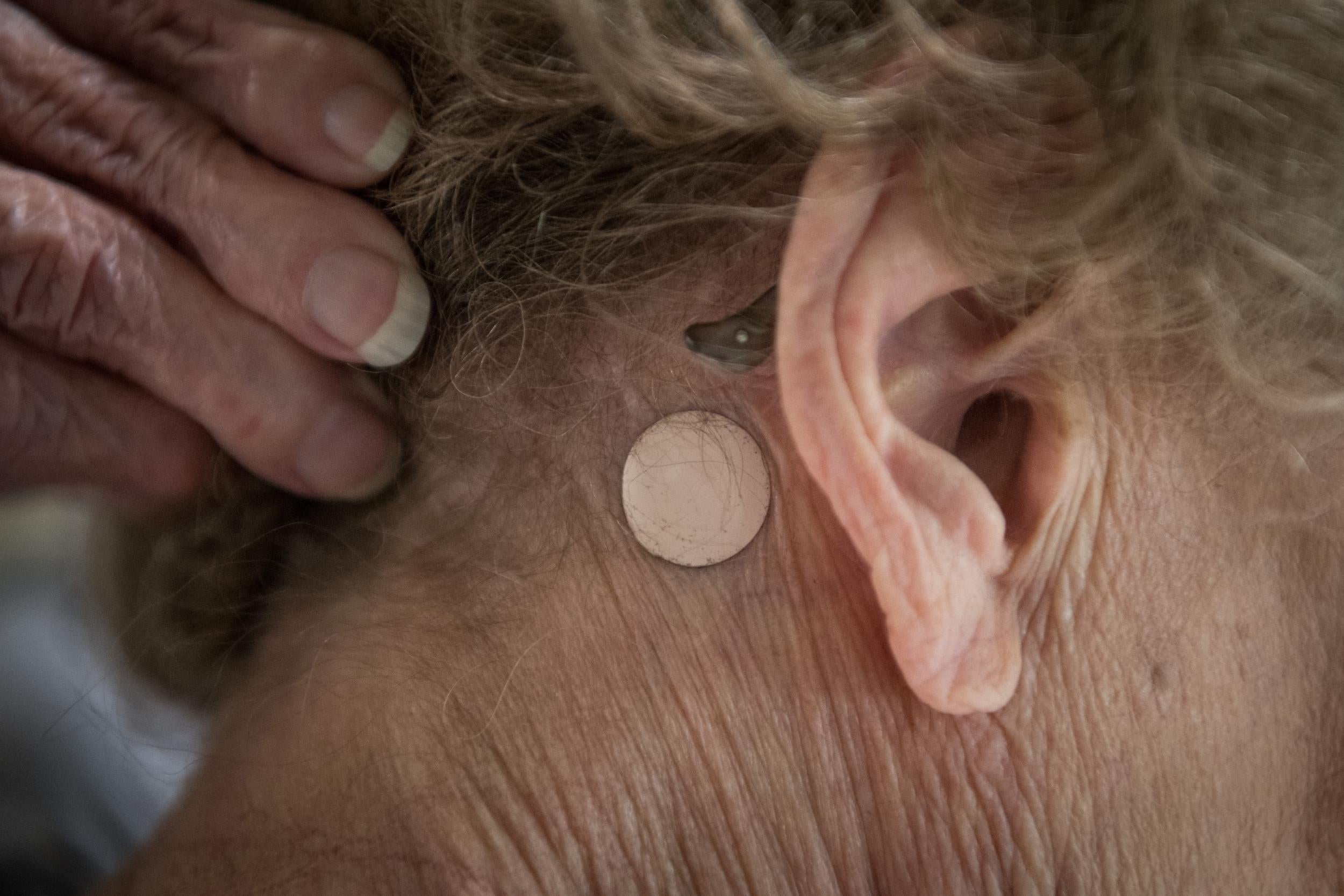 O’Connell displays a patch used to counteract her vertigo. Dilley says O’Connell has been left with damaged vision, hearing and balance (Loren Elliot for The Washington Post )