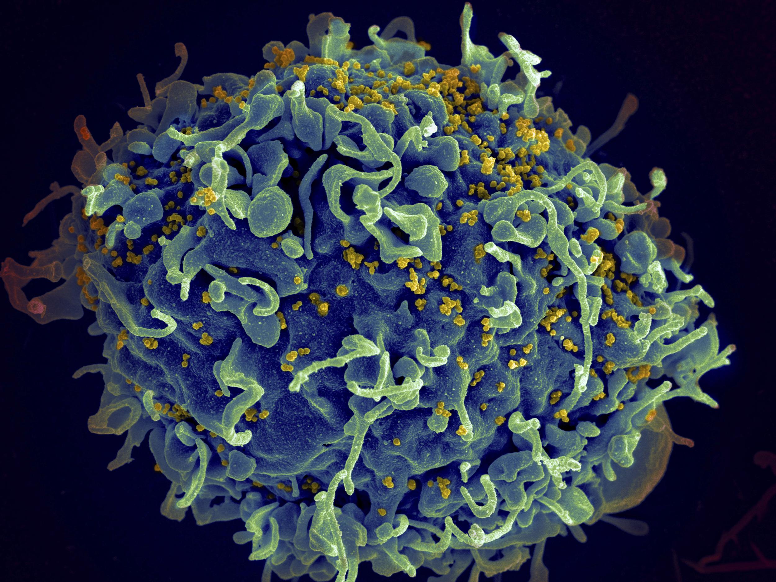 HIV (yellow) attacks human immune cells (blue) and can be kept suppressed with anti-retroviral drugs but before "Berlin patient" Timothy Ray Brown there was thought to be no cure