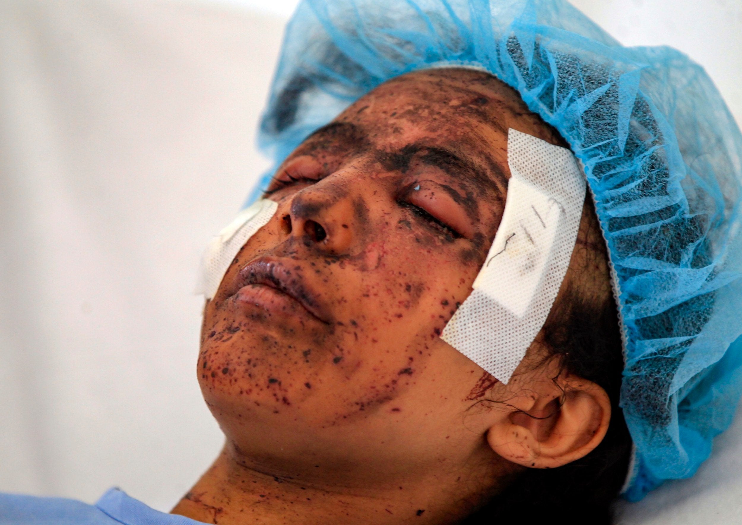 A Yemeni girl receives treatment at a hospital in the Huthi-rebel-held capital Sanaa on March 11, 2019, from wounds sustained during a reported air strike in the Kisar district of the northern Hajjah province