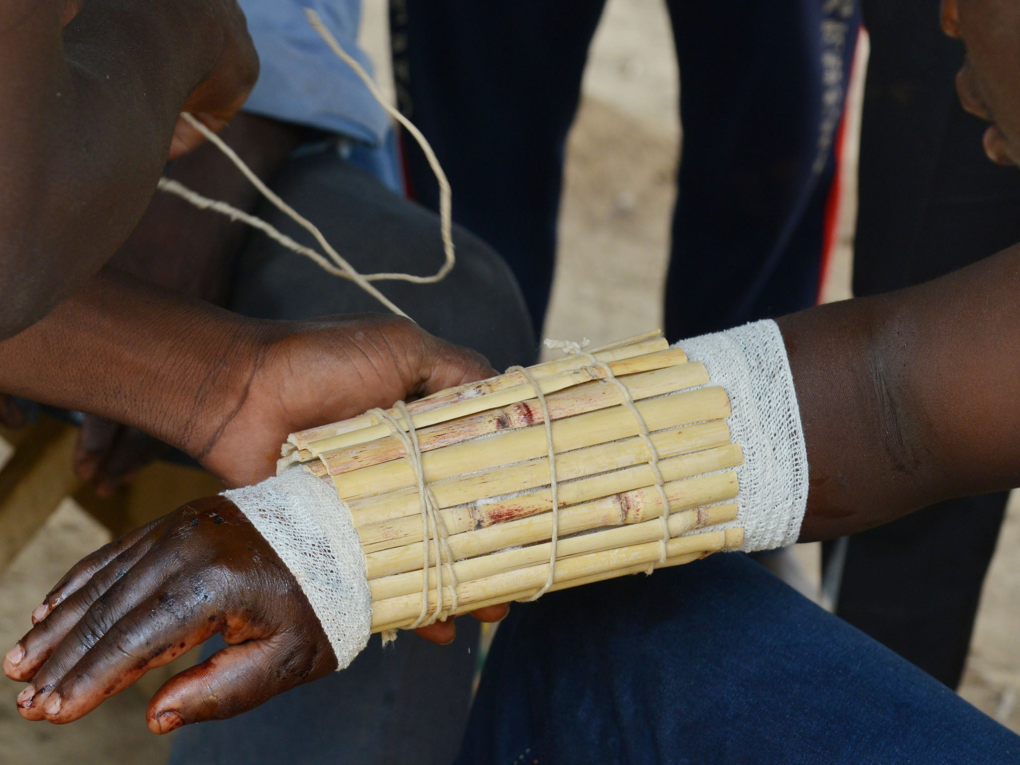 Folo Drissa Lougue, a healer from Kalembouly, wraps the fractured arm of a man. According to legend, descendants of the village have the gift of healing fractures and dislocated joints (AFP/Getty)