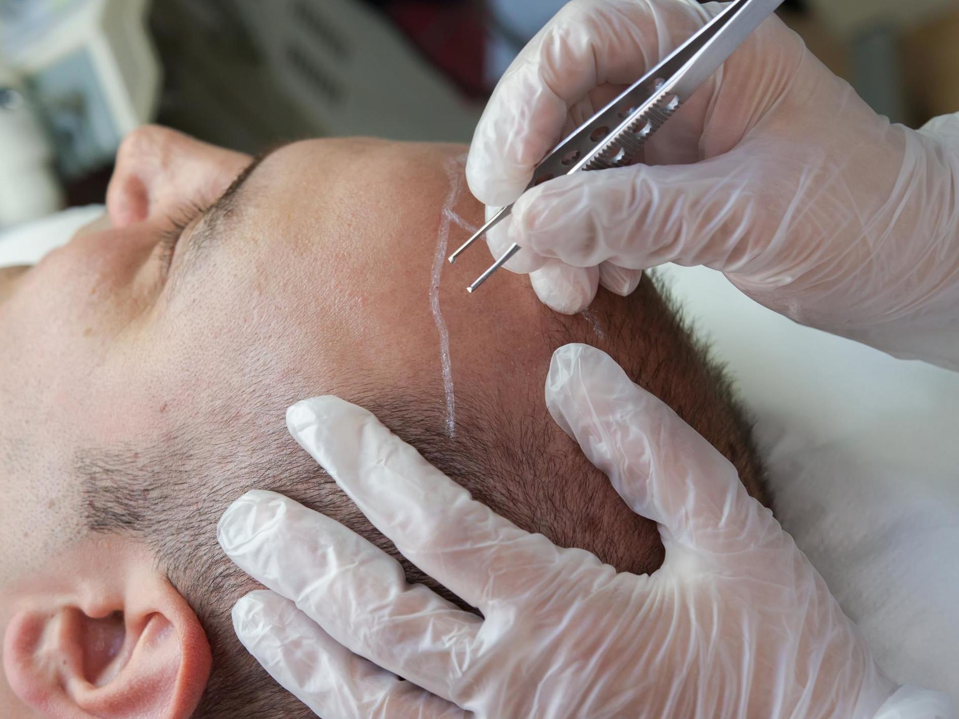 Other popular medical tourism procedures include hair transplants.