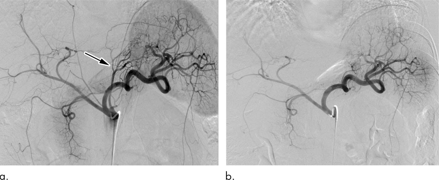 Two pictures show how blood flow to stomach is reduced after bariatric embolisation