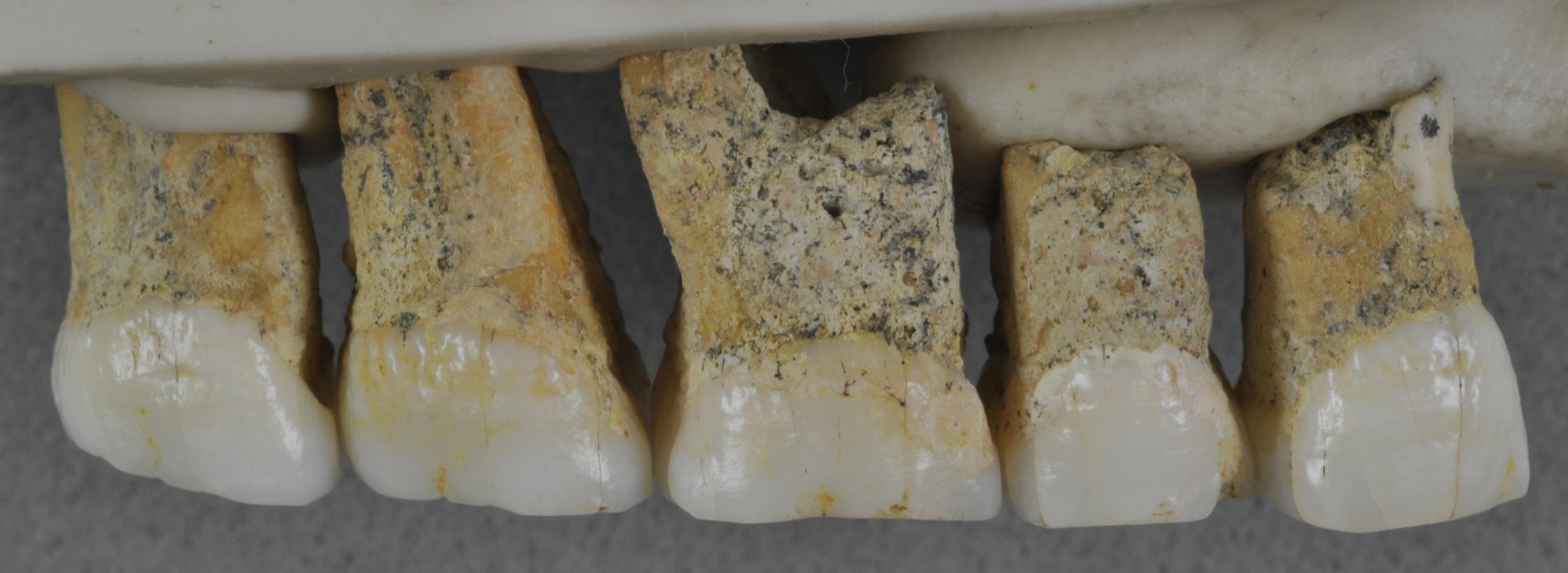 Upper teeth of a member of the new species Homo luzonensis