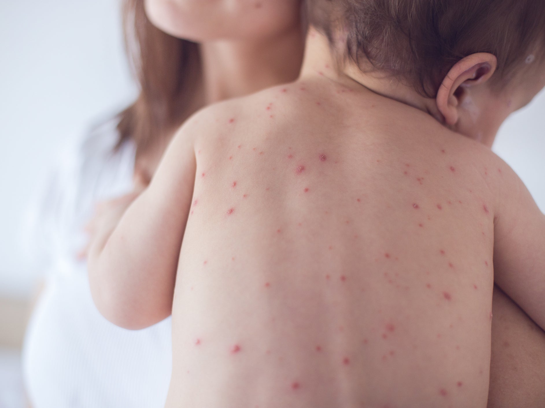 Measles cases are on the rise, says the WHO (Getty/iStock)