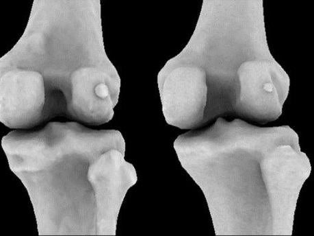 Fabellae (small knee bones behind the knee cap) are twice as common in people with osteoarthritis of the knee