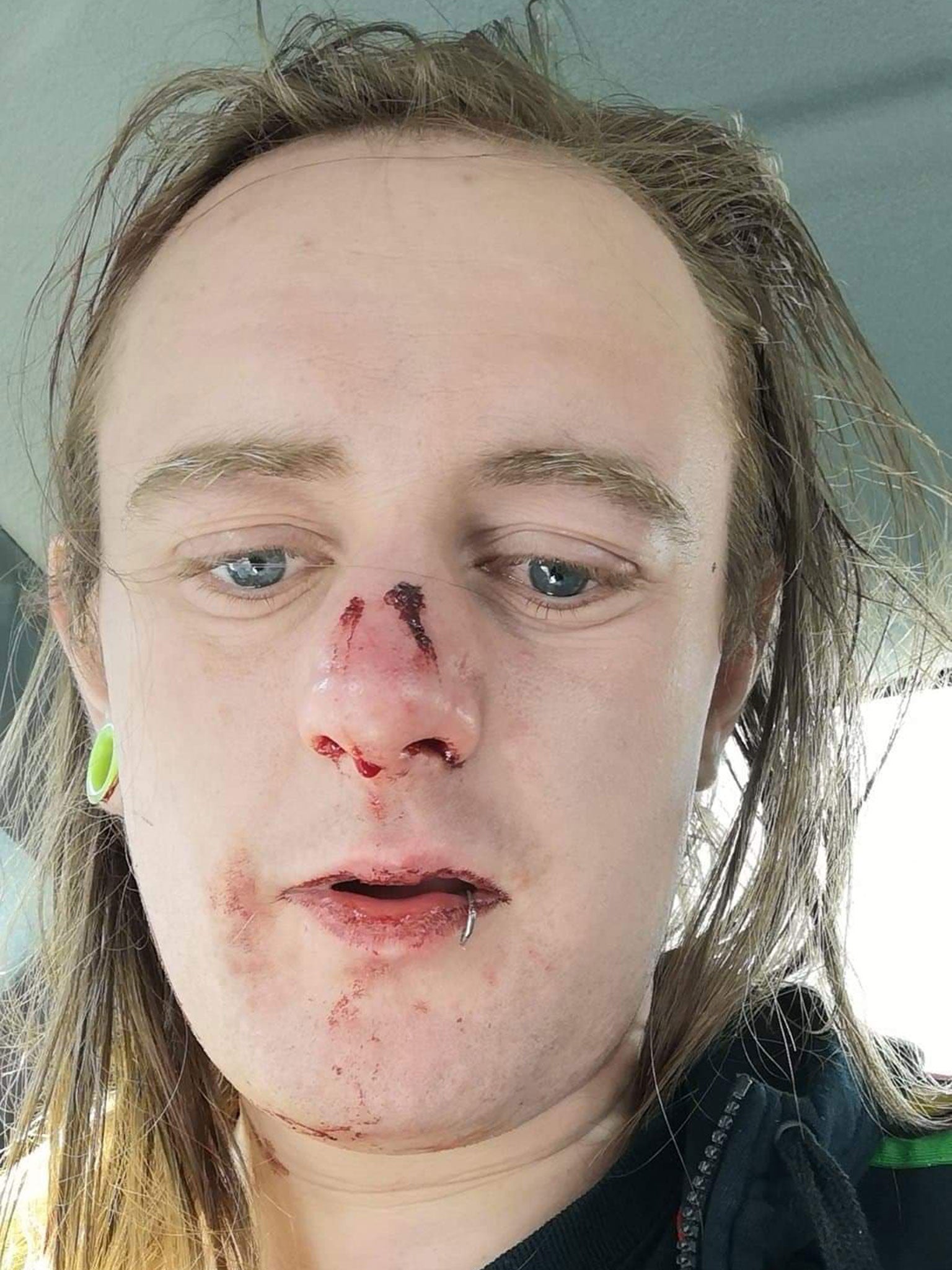 Alice Edwards said her nose was broken by Tommy Robinson supporters in Warrington on 2 May