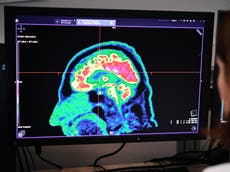 Previously 'untreatable' childhood brain cancer could be beaten with new type of drug