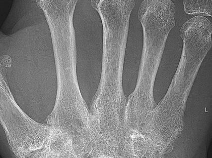 X-ray of the wrist of a 66-year-old woman with rheumatoid arthritis: the BMJ has said regular intake of supplements for arthritis and joint pain may lower the risk of heart disease and stroke