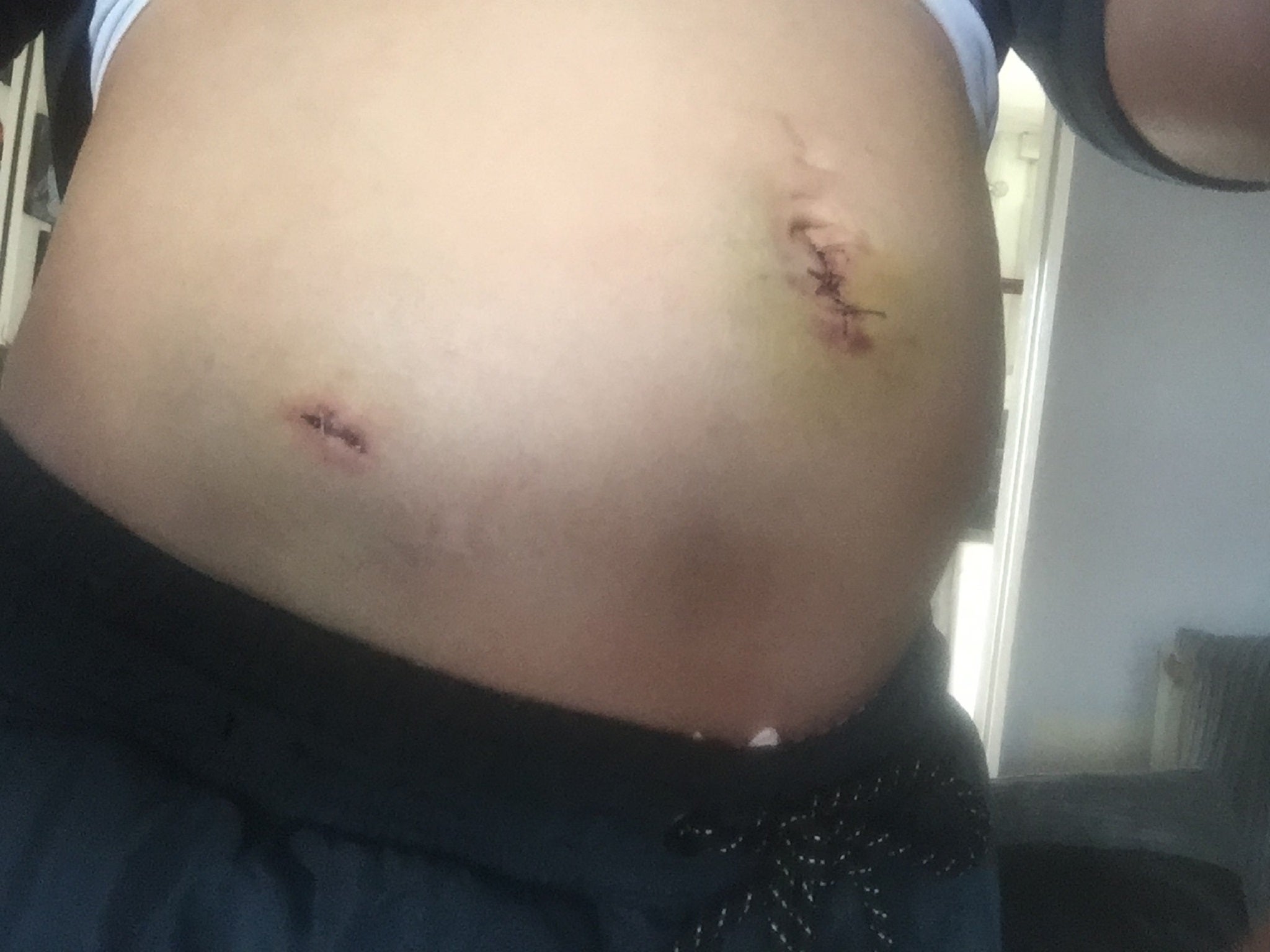 The scars left after two surgeries to remove fallopian tubes