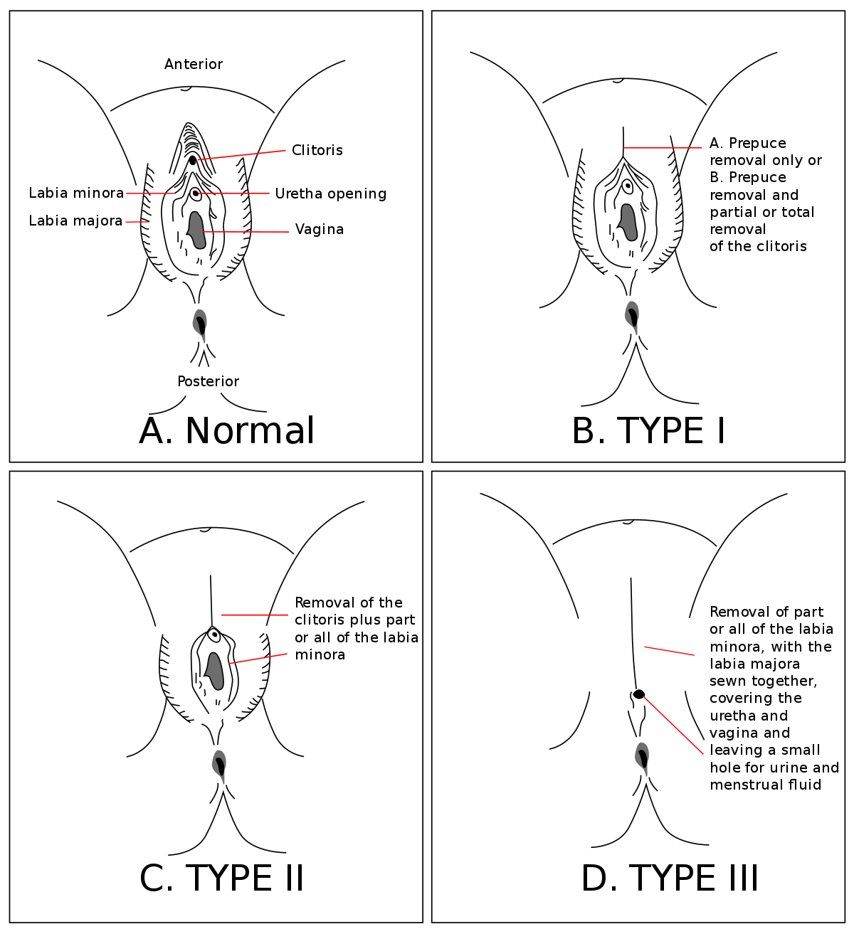 The main types of female genital mutilation