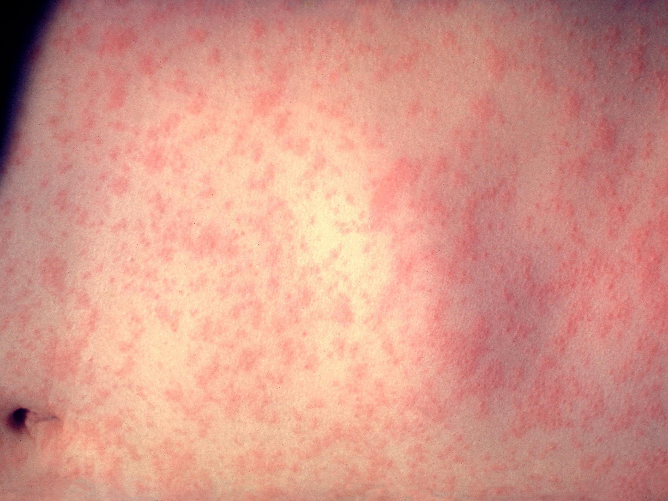 Related video: World Health Organisation warns of global rise in measles cases