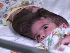 Conjoined twins joined at skull separated after 50 hours of operations