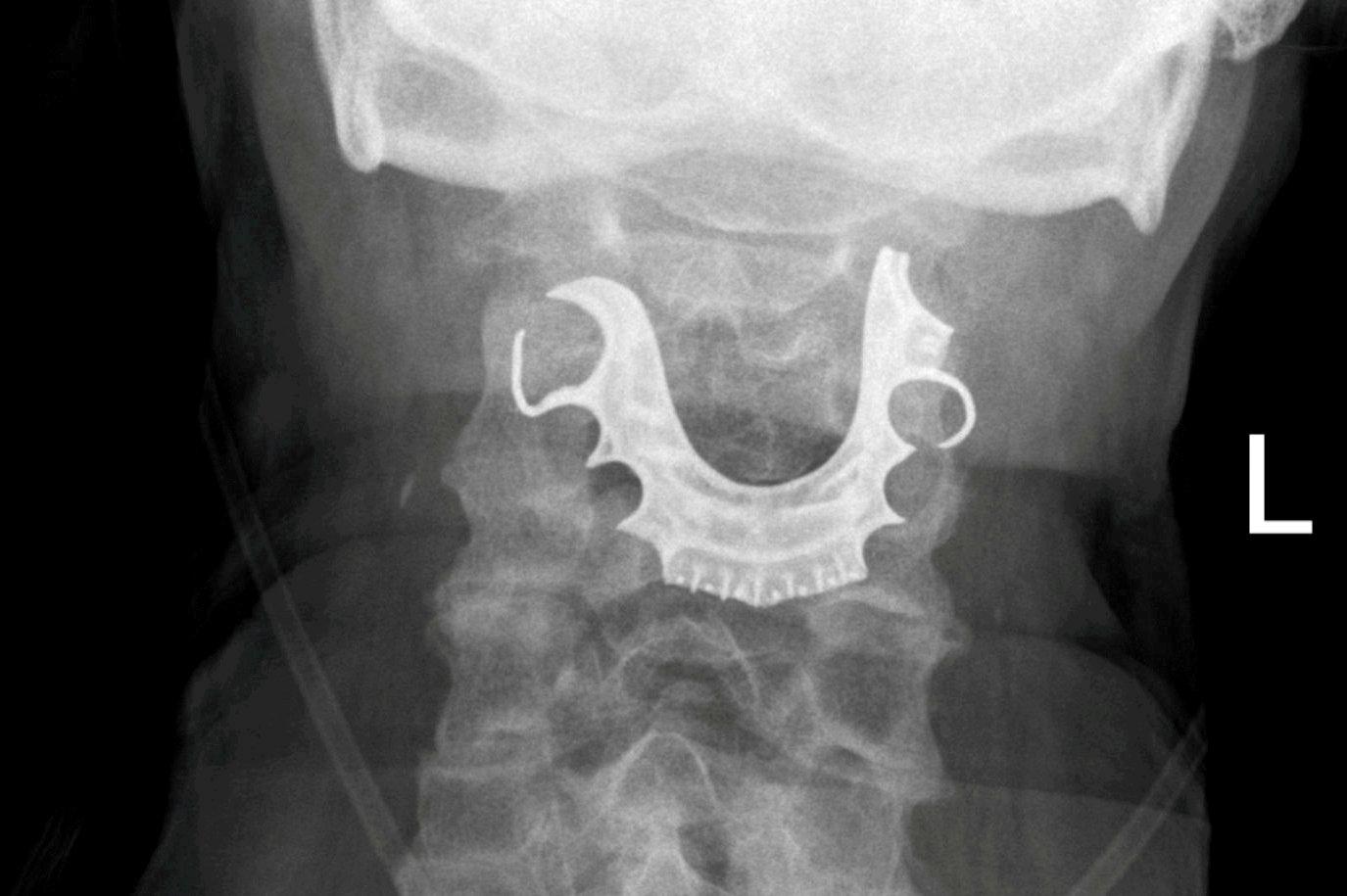 X-ray shows dentures in patient’s throat after surgery