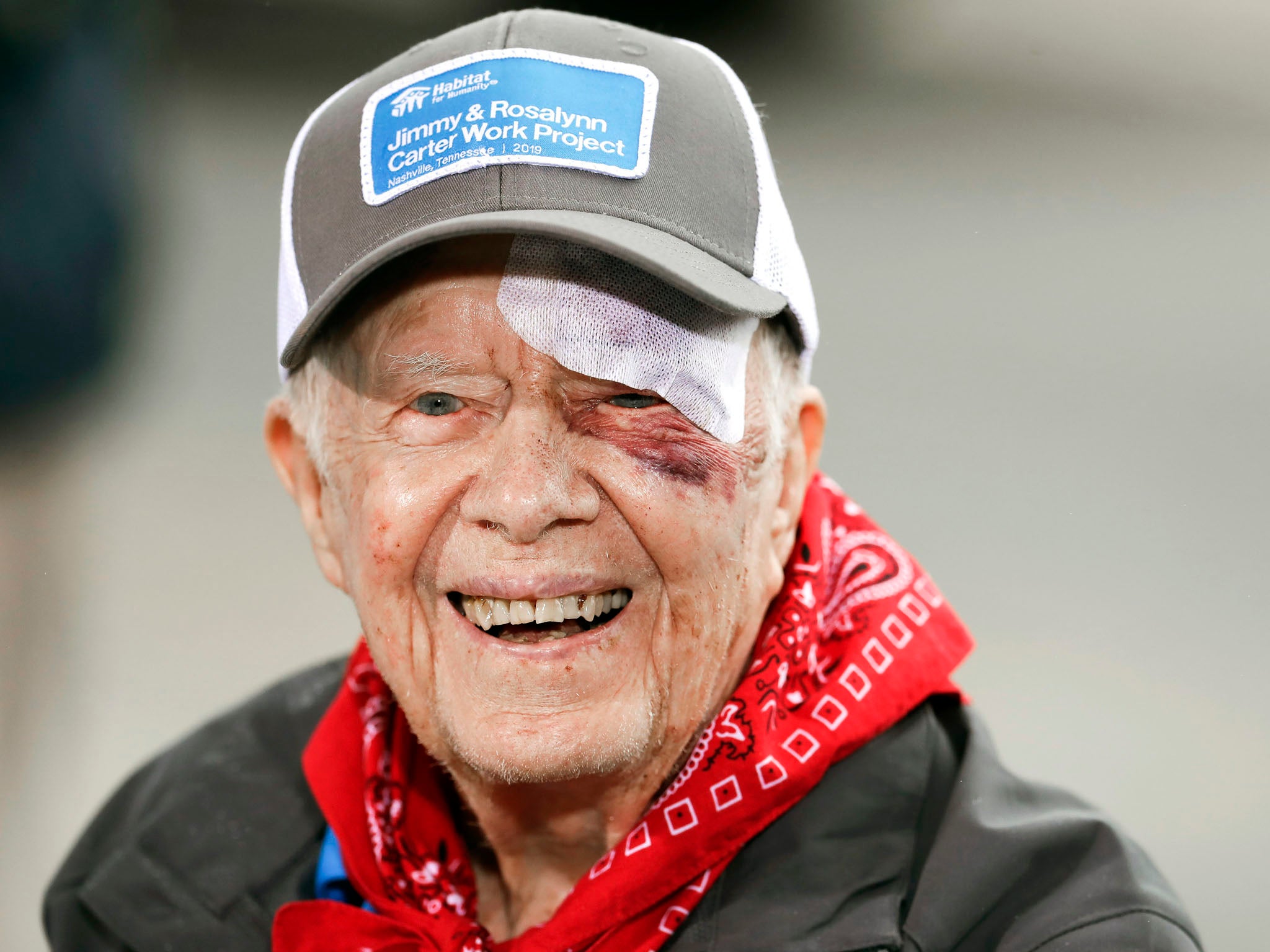 Former President Jimmy Carter said his wound required 14 stitches.