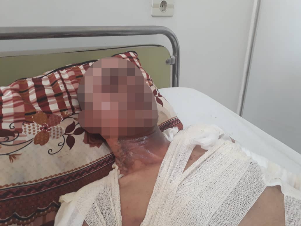 A man with severe facial burns is treated in Hasakah