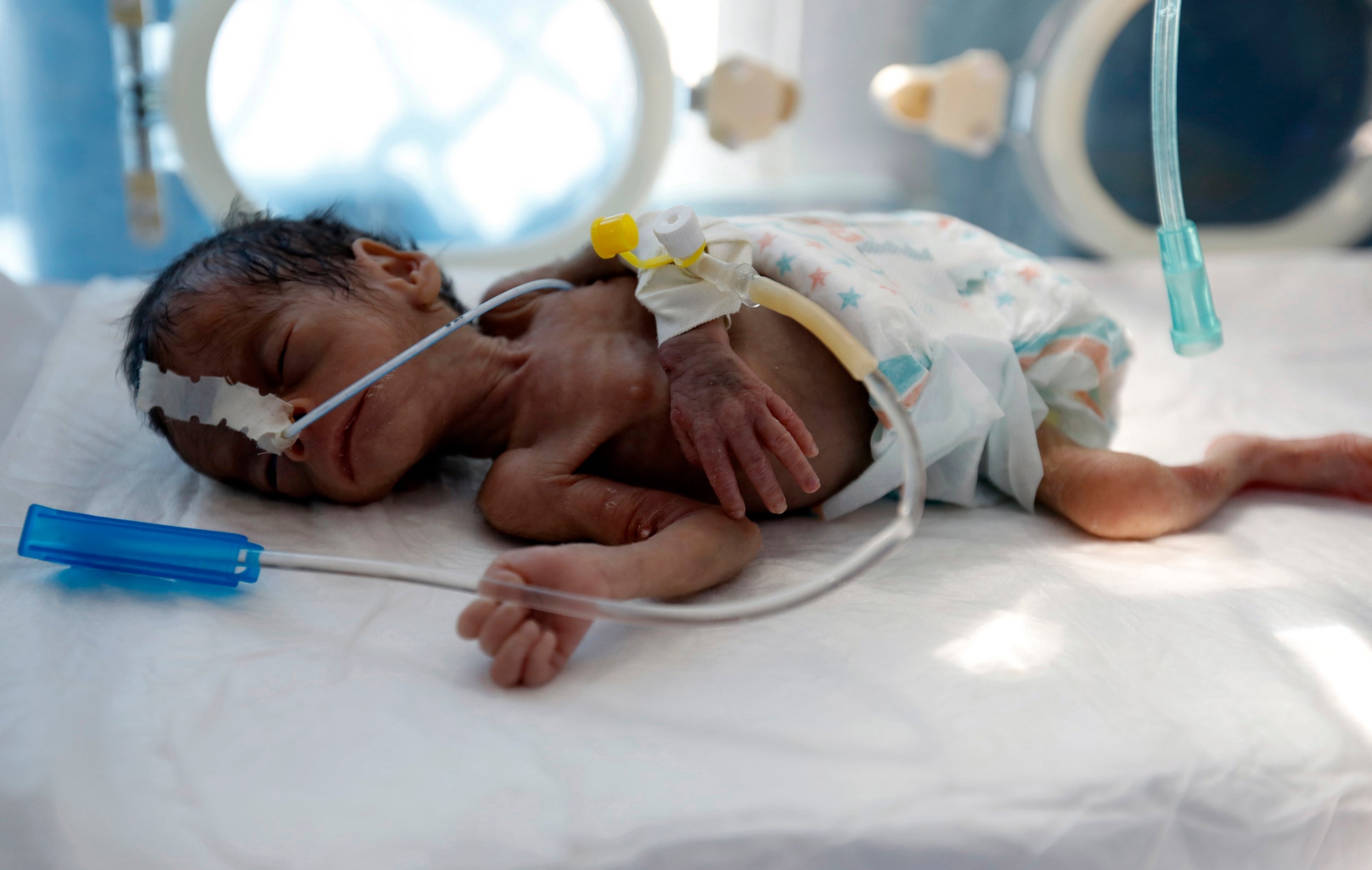 A malnourished baby lies in an incubator in the neonatal intensive care unit of a hospital in Sana'a, Yemen