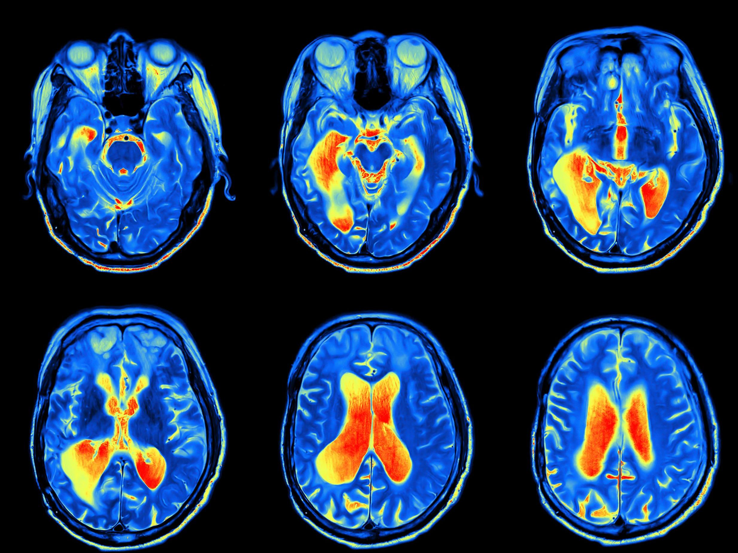 Researchers from the German Centre for Neurodegenerative Diseases followed 2,013 adults from 1997 through to 2012