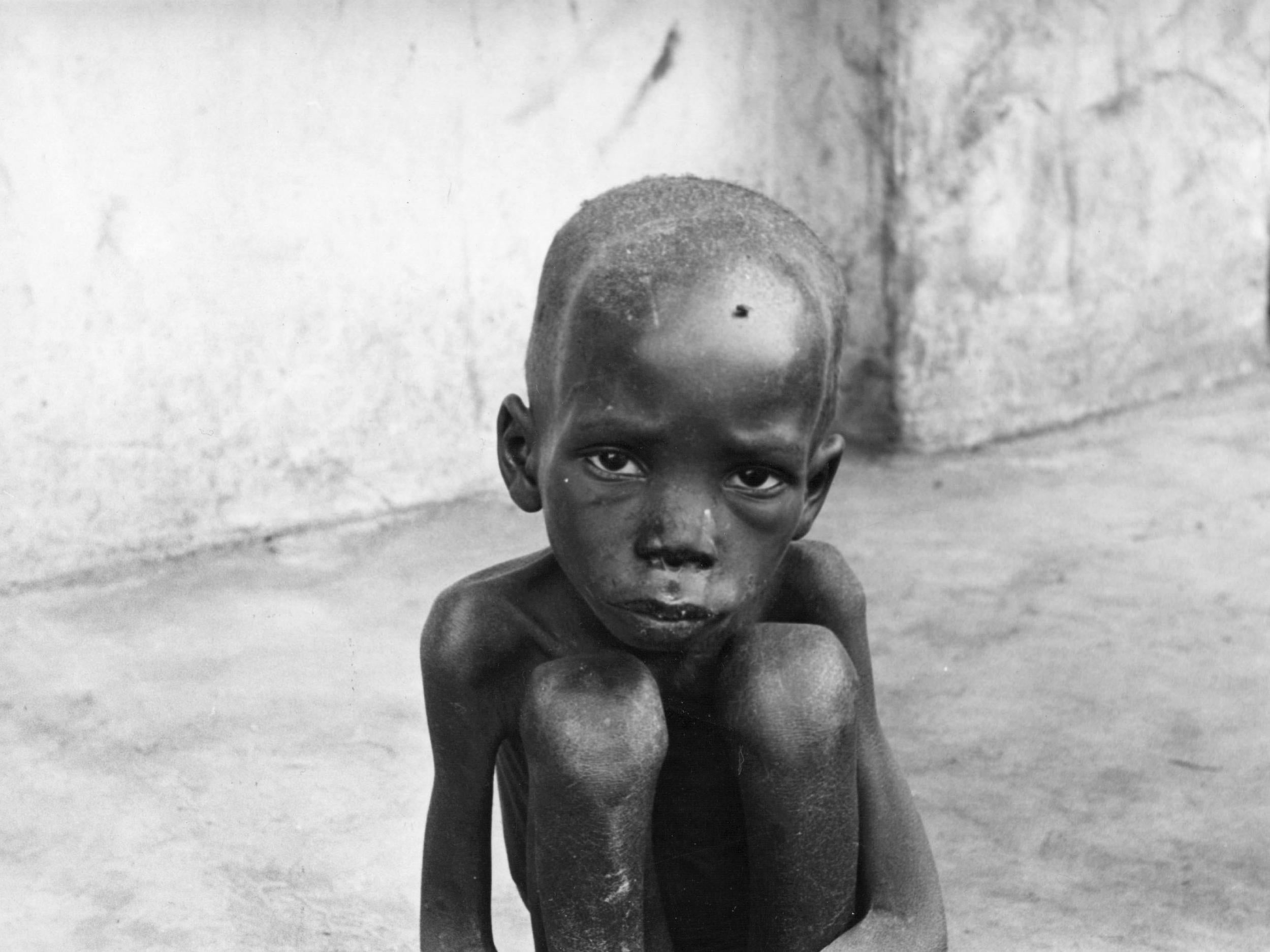 Thousands of Biafran children like this suffered extreme starvation during the war