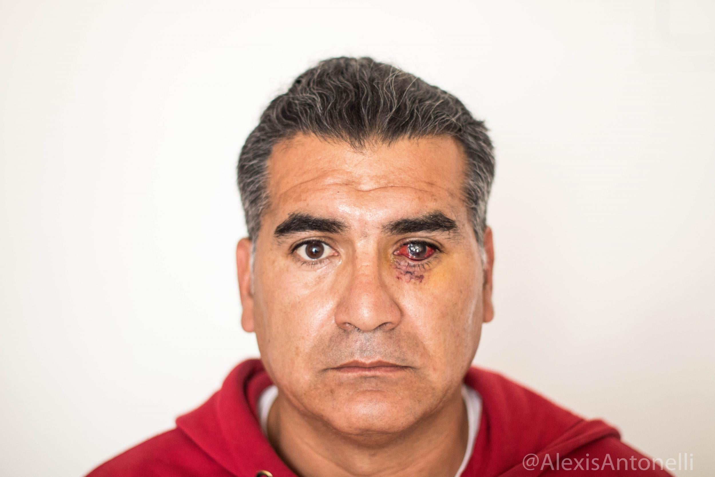 Albano Toro Cardenas says he was shot in the eye by security forces