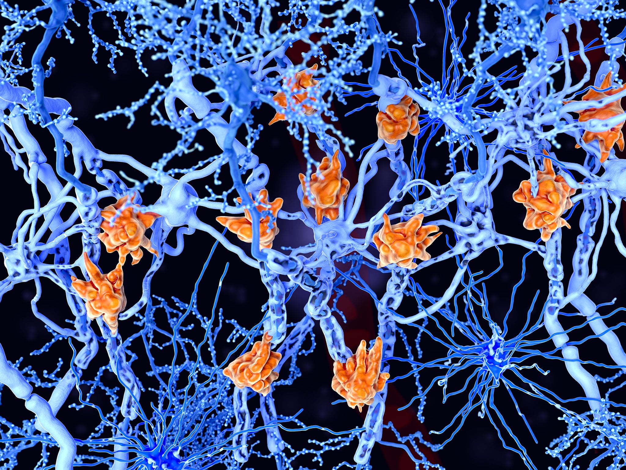 Microglia cells (orange) attack the oligodendrocytes that form the insulating myelin sheath around neuron axons, leading to the destruction of the myelin sheath and to the loss of nerve function (Getty/iStock)