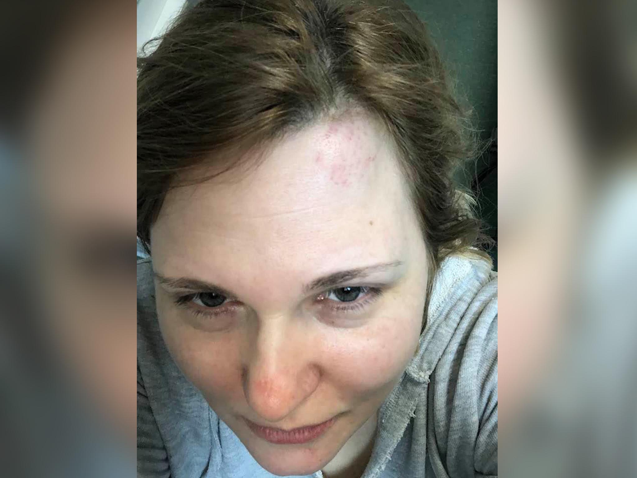 Investigative journalist shows a mark on her head after being attacked