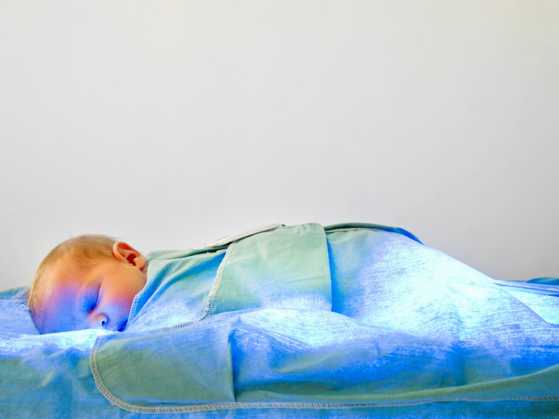 A newborn girl undergoing phototherapy treatment for jaundice, a very common newborn condition