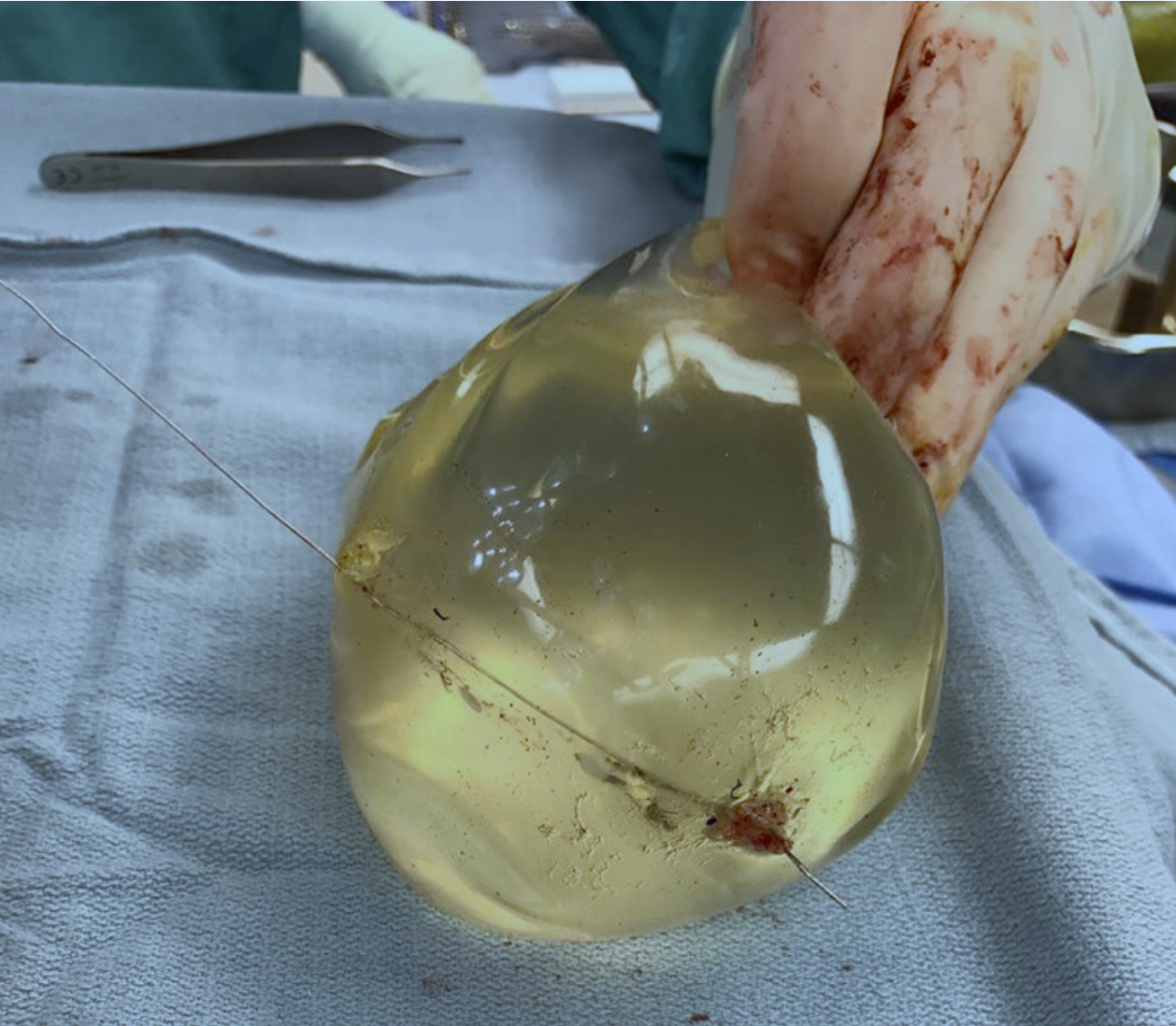 Intraoperative view of left breast implant showing bullet trajectory through implant