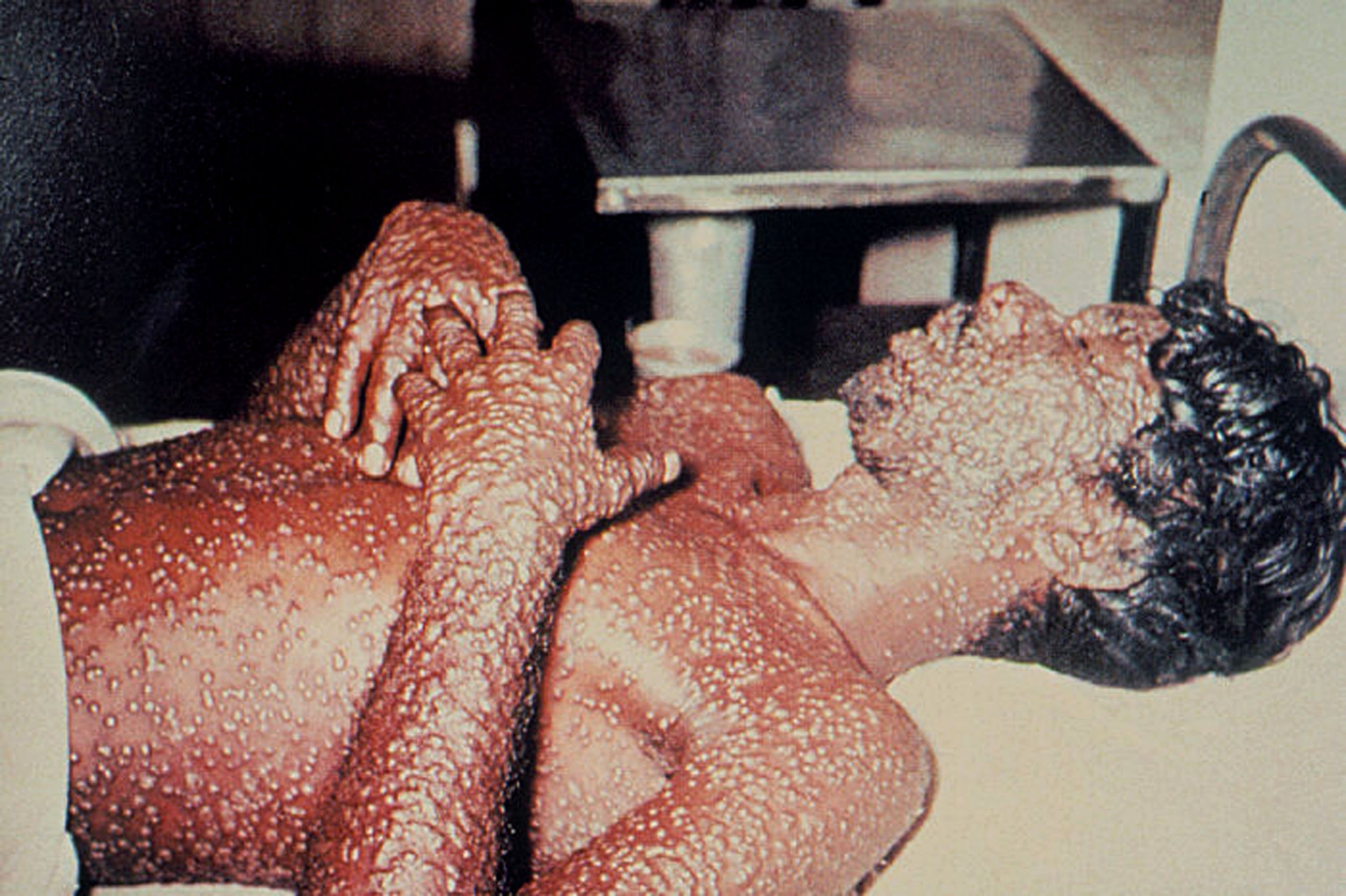 Victim of smallpox, a killer disease that did not discriminate