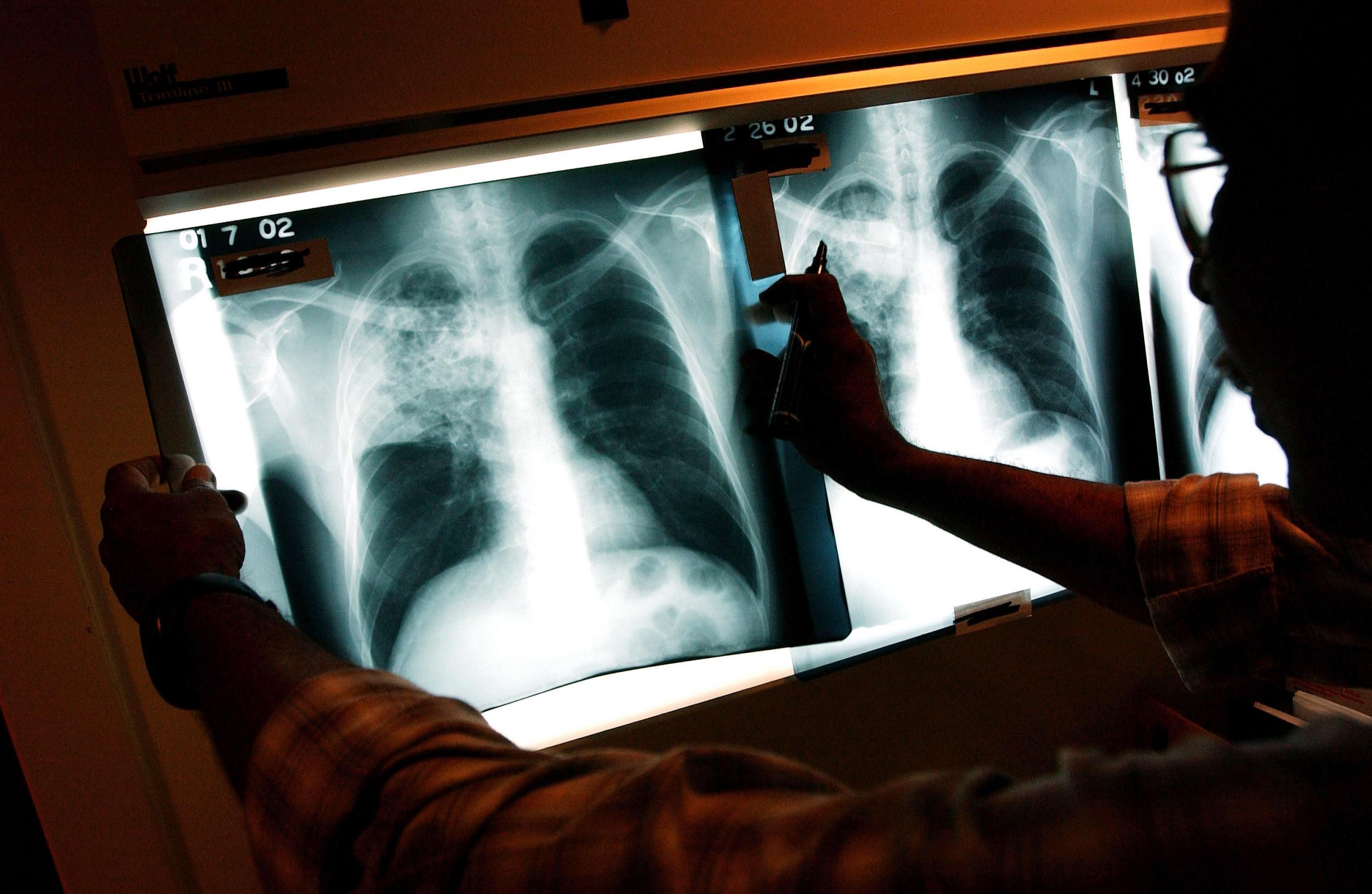 A doctor examines the X-rays of a TB patient in Brooklyn Getty)