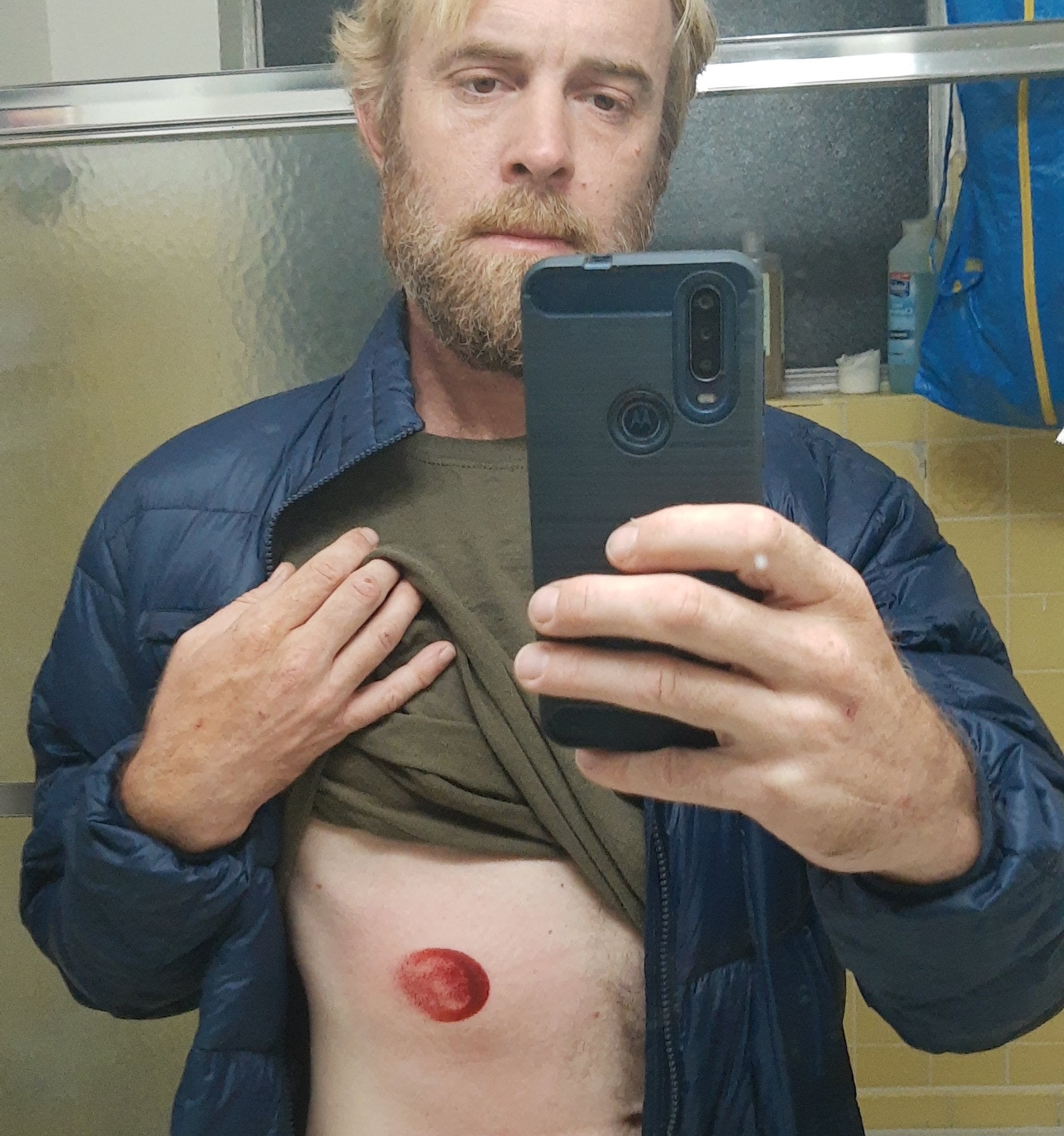 Lawyer Todd Gallinger shows his injuries after he says he was shot with a rubber bullet during George Floyd protests in Long Beach, California