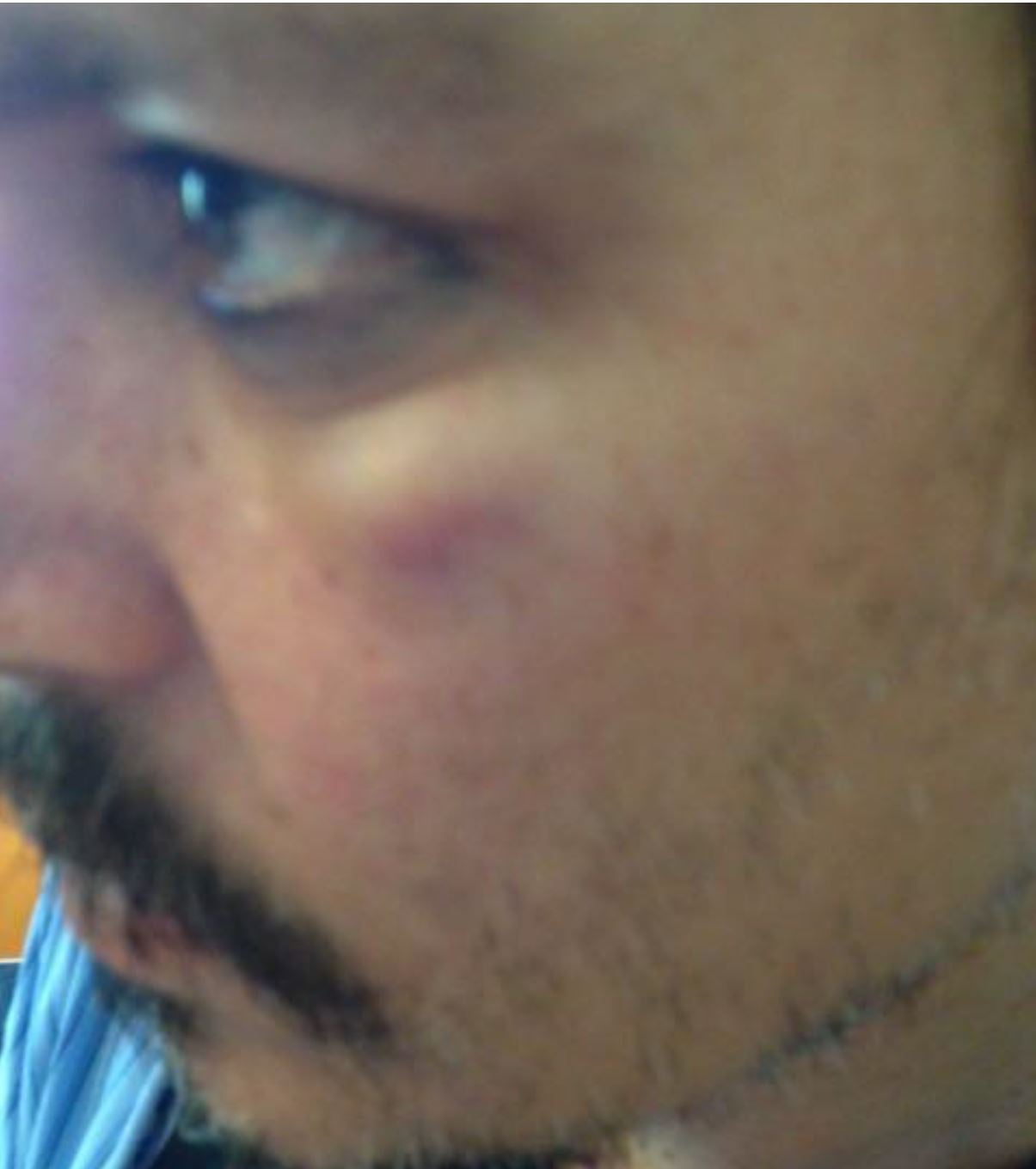 Photo of Depp with injuries allegedly sustained from Heard during an incident in Los Angeles in March 2015