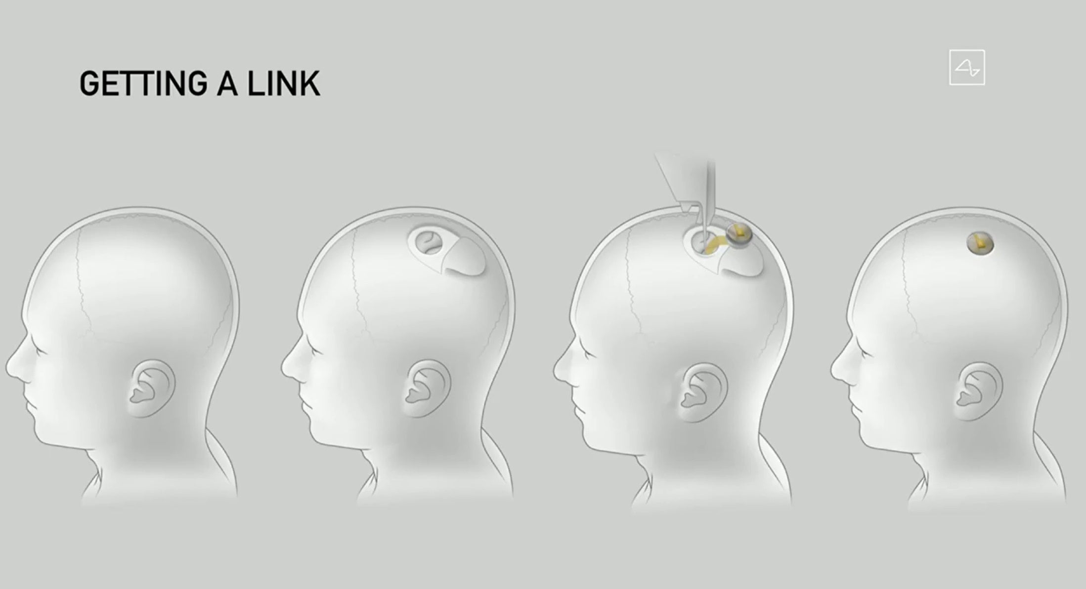 Elon Musk said the Neuralink device would replace a piece of skull without causing any lasting damage to the brain