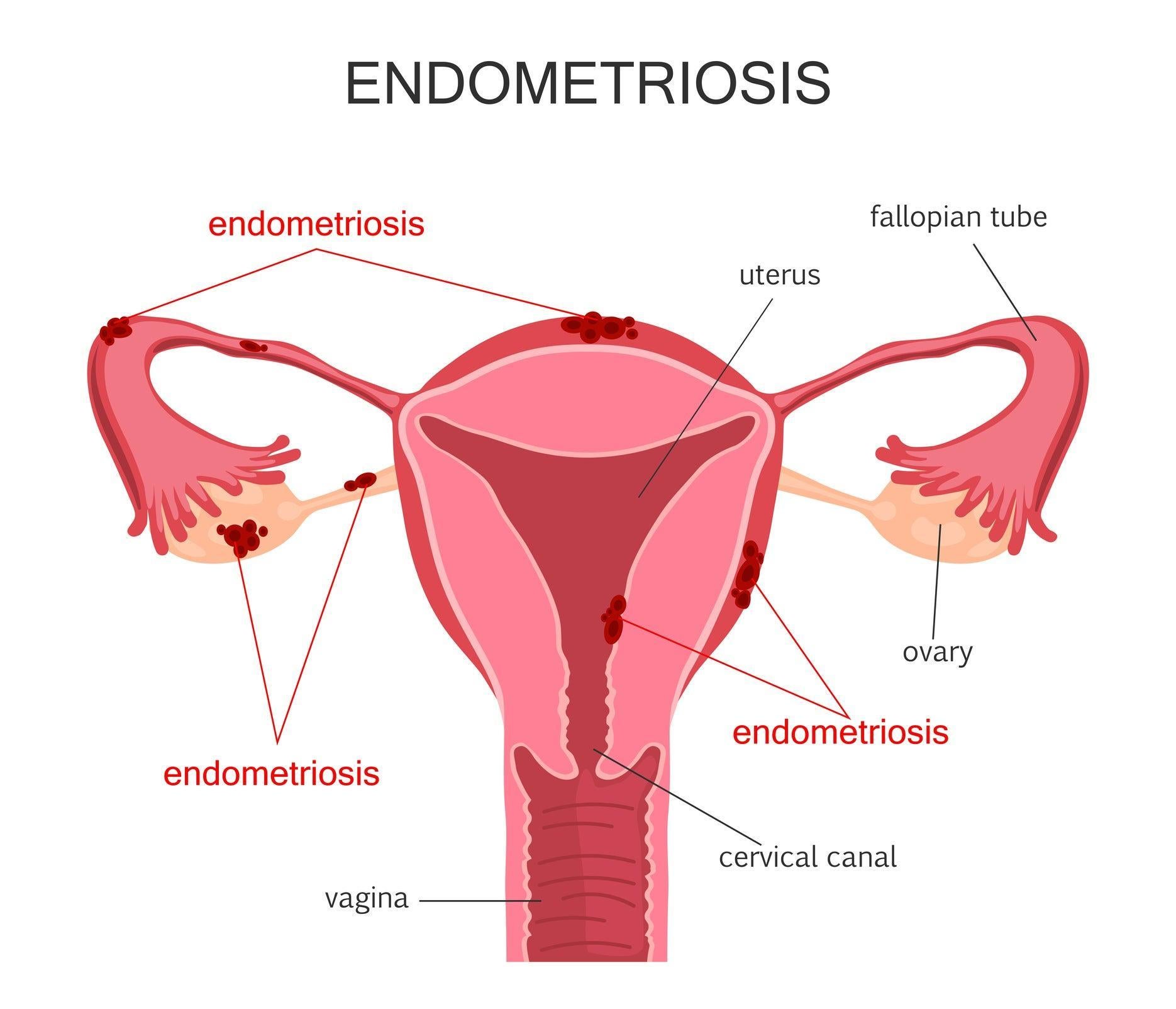 Endometriosis is a common condition that can cause cysts