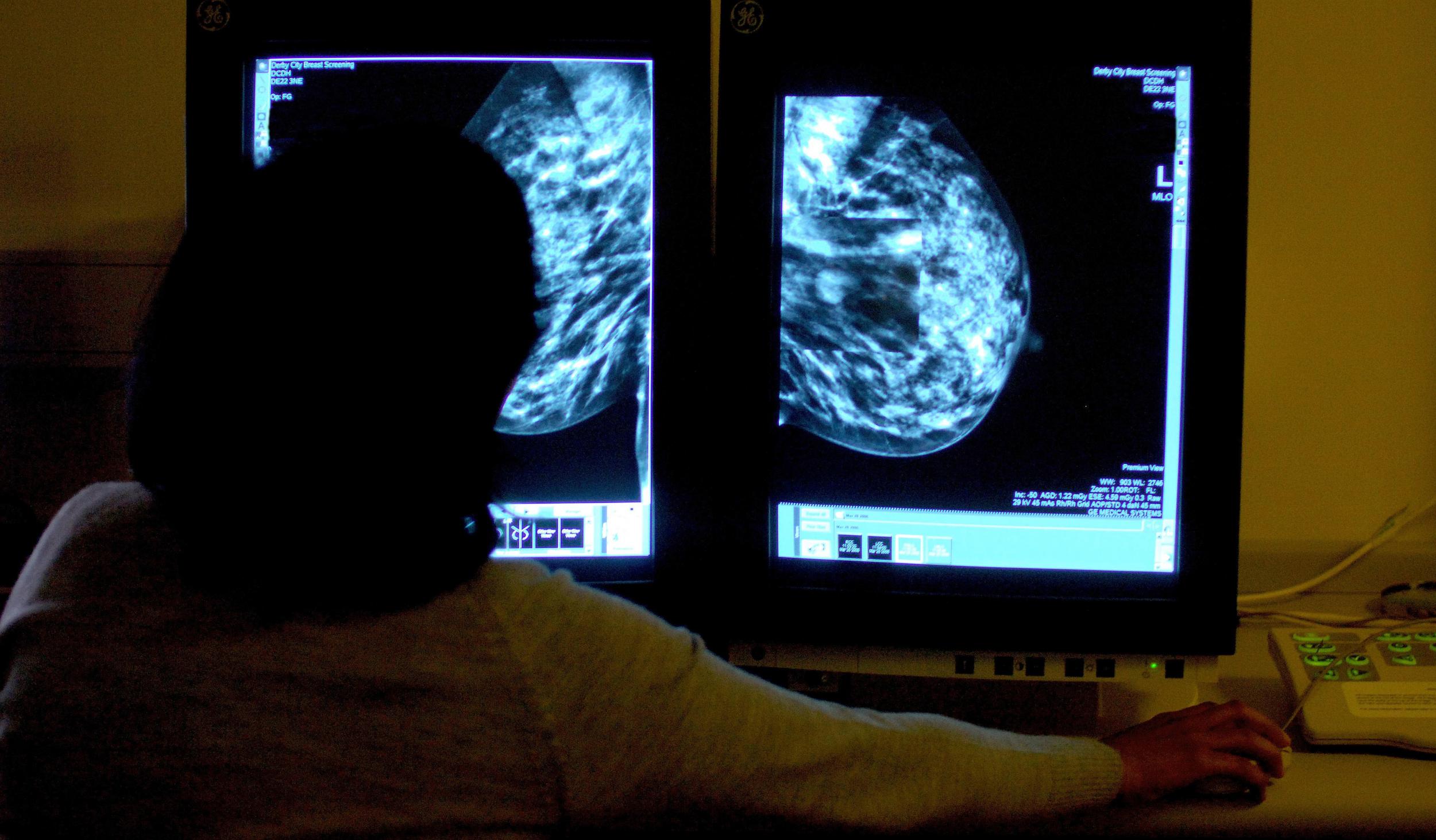 A doctor looks at a mammogram used to detect signs of breast cancer